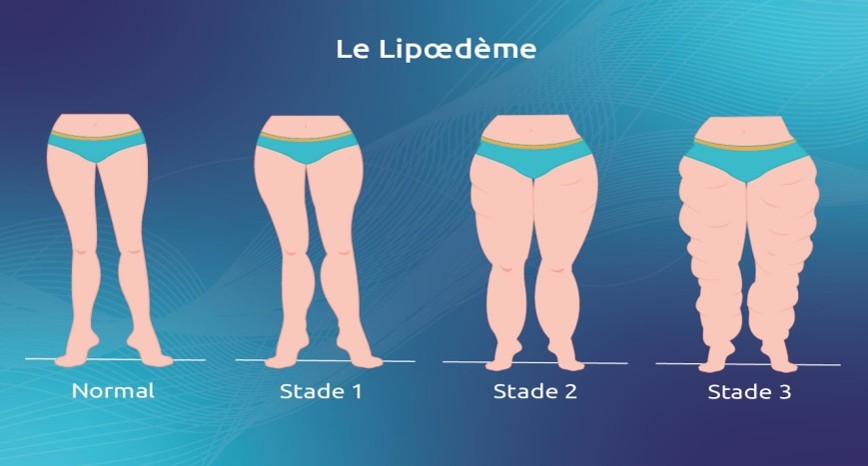 lipoedeme